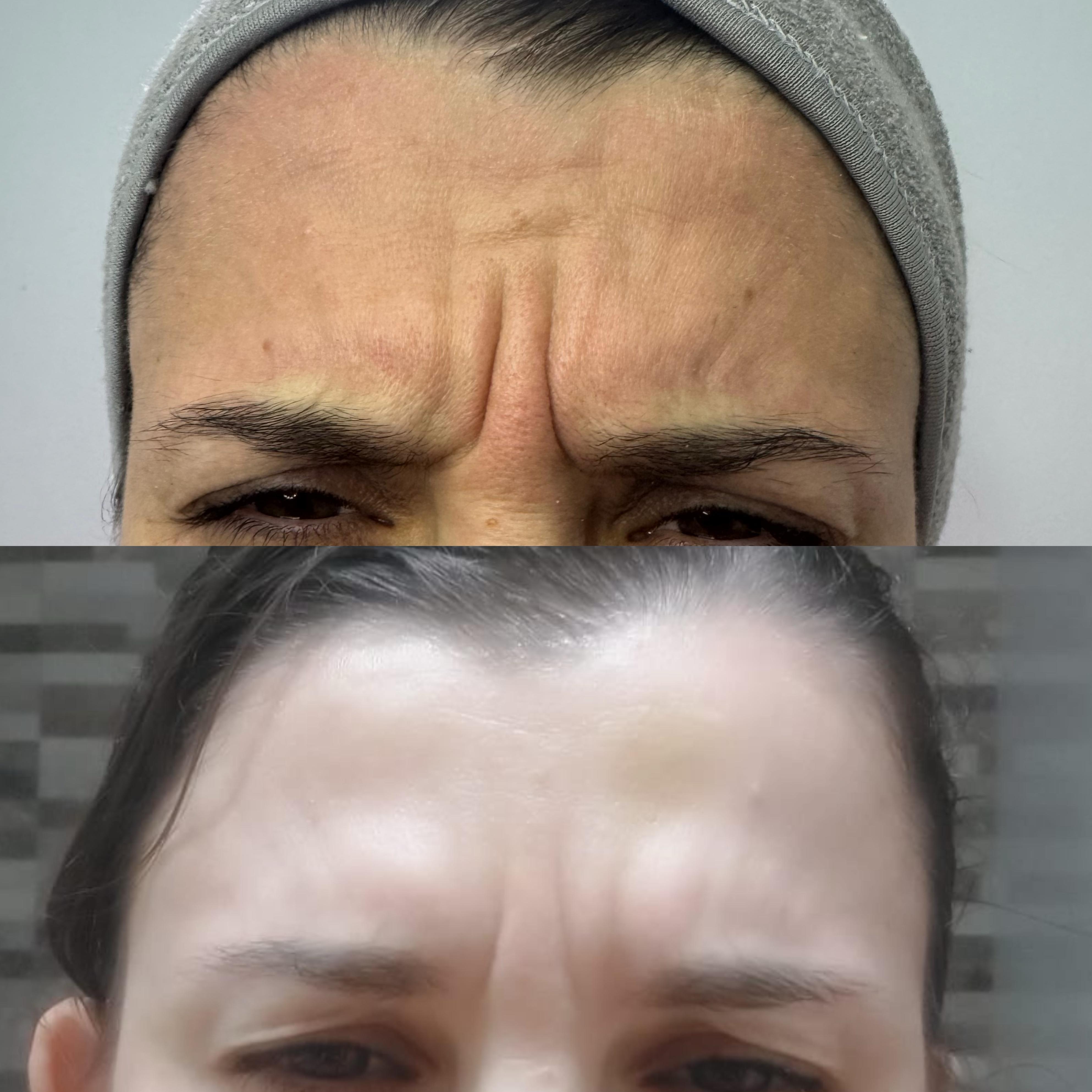 Antes e depois mostrando suavização visível de linhas de expressão na testa